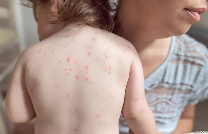 Treat Common Baby Skin Rashes at Home