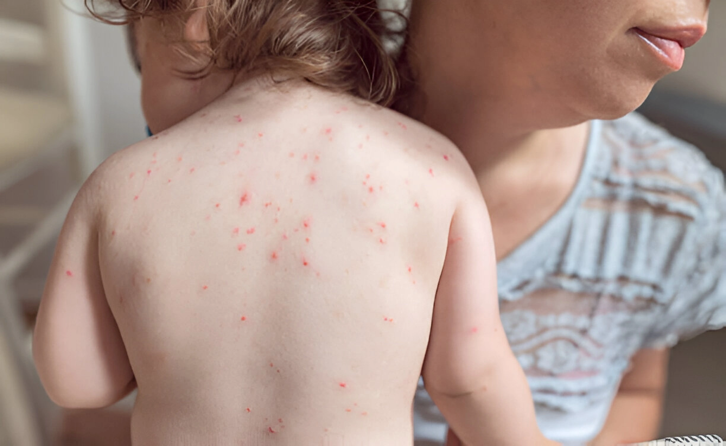 Treat Common Baby Skin Rashes at Home